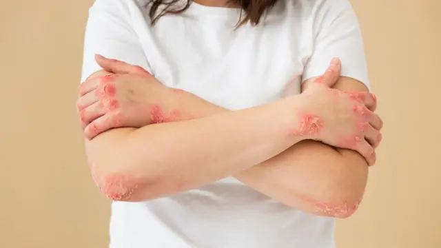 How Can a Dermatologist Help to Get Rid of Eczema